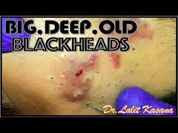 Pimple popper's instagram videos, this blackhead removal process takes a while. Big Deep Old Blackheads Removal By Dr Lalit Kasana 08 05 2019 Youtube