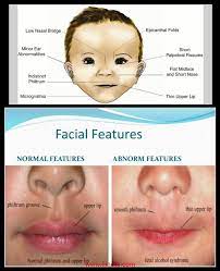 Epicanthic fold, also called epicanthal fold, fold of skin across the inner corner of the eye (canthus). Fetal Alcohal Syndrome Microcephaly Fetal Alcohol Syndrome Fetal Alcohol Microcephaly