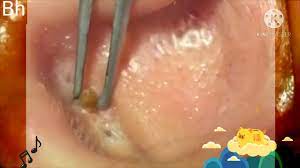 Es, there are effective blackhead removal treatments, and you can begin the steps the best acne solutions aren't in removal tools, creams, or even medications: Biggest Blackhead Removal Videos 2019 Large Blackheads Removal Best Pimple Popping Youtube