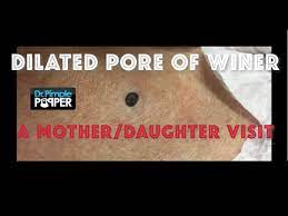 Thanks for watching this video: Best Dr Pimple Popper Blackhead Extraction Videos Ever