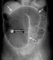 Coffee Bean Sign Sigmoid Volvulus Radiology Imaging Radiology Radiology Humor