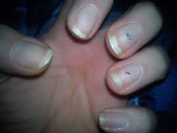 I recommend you to seek professional help if your nails hurt for over 5 days. A Word Of Warning The Aftermath Of Acrylic Nails The Life And Times Of Jvs