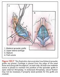 The bridge of my nose is a bit high. Spreader Grafts Beverly Hills Rhinoplasty