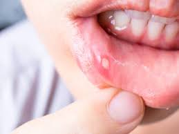 Here S What You Can Eat To Cure Mouth Ulcers Times Of India