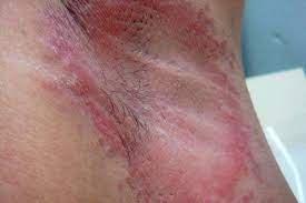 Intertrigo refers to a type of inflammatory rash (dermatitis) of the superficial skin that occurs within a person's body folds. Armpit Rash Itchy Candida Causes Treatment