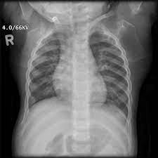 Achondroplasia Radiology Case Radiopaedia Org Achondroplasia Radiology