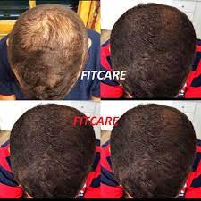 Sac Cikaran Losyon Sac Dokulmesini Engelleyen Solusyon Fitcare Hair Sac Losyonu Sakal Serumu Sampuan Bitkisel Kur Sampuan Sac Sakal