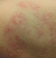 #spidernevi #liverdisease #alcoholicliverdisease for dr. Spider Angioma Wikiwand