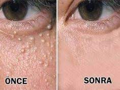 Goz Cevresindeki Beyaz Yag Bezeleri Nasil Gecer Sosyolife Net Cilt Bakimi Akne Tedavisi Cilt Bakimi Tuyolari