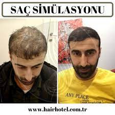 Sac Simulasyonu Sac Ikiz
