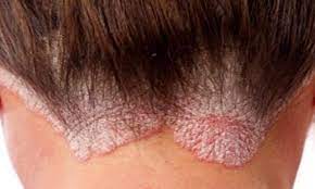 Seboreik Dermatit Nedir Cilt Beyazlatma Sac Dogal Tedaviler