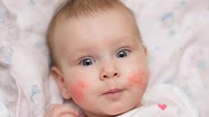 Bebeklerde Cilt Hastaliklari Nelerdir Guncel Yasam Haberleri