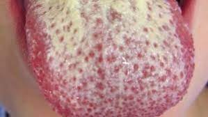 George ghidrai, medic specialist medicina dentara. Bolile Limbii Lichen Plan Candidoza Afta Bucala Limba Geografica