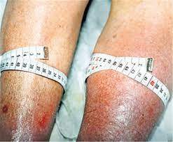 Eine thrombose im arm ruft eindeutigere symptome hervor als eine thrombose im bein. Nach Thrombose Jahrelang Schlechte Prognose