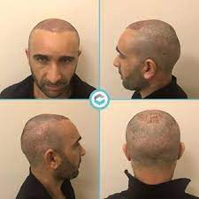 Micro Fue Sac Ekimi Detayli Bilgi Ve Ucretsiz Konsultasyon Icin Iletisim 90 216 493 1020 Sackoku Sacekimi Sactedavileri Sacekimiistanbul Sacdokulmes