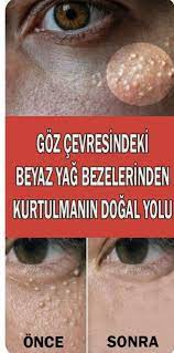 Goz Alti Yag Bezeleri Nasil Gecer Health Fitness Health Beauty