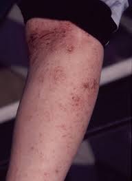 Retrouvez toute l'actualité et les fiches santé sur mst: Dermato Zoonoses L Animal Responsable De Maladie De La Peau De L Homme