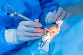 Goz Eti Pterjium Tedavisi