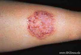 Les vers sont des parasites courants chez le chat. Dermato Zoonoses L Animal Responsable De Maladie De La Peau De L Homme