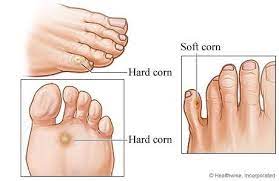 Multi dintre noi avem probleme cu talpile din cauza bataturilor inestetice care ne provoaca si disconfortul in timpul mersului. Tratament Naturist Bataturi Calozitati