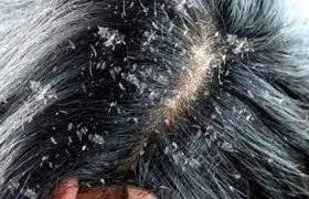 تفسير حلم رؤية قشرة الشعر فى المنام تفسير حلم قشرة الرأس