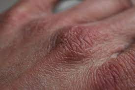 Les traitements du cancer du sein peuvent parfois engendrer bon nombre de complications et effets secondaires sur l'organisme. Syndrome Main Pied Post Traitements Du Cancer Du Sein Infos A Retenir