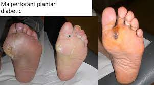 Asadar, include in ritualul de frumusete aceste metode simple de a ameliora o problema atat de des intalnita. Bataturile Piciorului Cauze Si Tratament