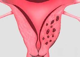 Deze vorm van endometriose bevindt zich in de wand van de baarmoeder, tussen het spierweefsel. Adenomyose Og Graviditet Symptomer Og Behandling Af Adenomyose Under Graviditet Kompetent Om Sundhed Pa Ilive