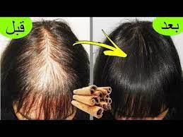 مكون في كل بيت ينبت الشعر في مقدمة الراس بسرعة والنتيجة مبهرة تعالج الصلع والتساقط الشديد Youtube Hair Care Oils Treat Hair Fall Hair Styles