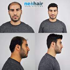 Nano Teknoloji Ile Protez Sac Dogalligi Www Neohair Com Tr 0212 296 26 26 Protezsac Hairstyle Sacmodelleri Sacbakimi Neohair Sac Trendler Sac Bakimi