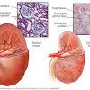 Chronic kidney disease (ckd) is a type of kidney disease in which there is gradual loss of kidney function over a period of months to years. Https Encrypted Tbn0 Gstatic Com Images Q Tbn And9gctobjph0mrm76bdna3bpqgcl4zscsjhnln9gex8y5c9ldx6wjbzb7 Hd Ilu0z7n2nrg00s3bqtq Usqp Cau Ec 45781601