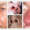 Most cases are easy to treat, but more severe infections may require additional treatment to avoid complications. Https Encrypted Tbn0 Gstatic Com Images Q Tbn And9gcql4gtygsorigi8yxa3oahta36mg6yffjio1po5rqj6tvwn0mq5jxwokrx1udlyablrhyl Jklkpa Usqp Cau Ec 45781601