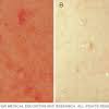 Here are the causes and treatment of spots. Https Encrypted Tbn0 Gstatic Com Images Q Tbn And9gcrr 2nsazrwfh Oh U Wwqygxhrzqsh2v Xdtv Zyu0v82y0wmju7nogosgka 0tjpfwlqle0odqa Usqp Cau Ec 45781605