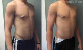 Gynecomastia Revision Surgery (of other surgeon's work) - Before and After  Photos ⋆ Gynecomastia USA