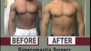 Connecticut Gynecomastia CT (Before and After) - Dr. Mordcai Blau - YouTube