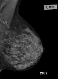 Lactating breast | Radiology Case | Radiopaedia.org