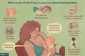 Breast Lumps: Clogged Milk Duct or Cancer?