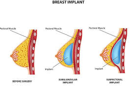 Breastfeeding and Pumping with Breast Implants | MIlk101 | Ameda