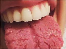 نتیجه جستجوی لغت [burning mouth syndrome] در گوگل