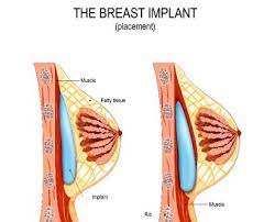 Breastfeeding After Cosmetic Breast Surgery | New Jersey