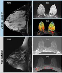 Breast MRI during pregnancy and lactation: clinical challenges and  technical advances | Insights into Imaging | Full Text
