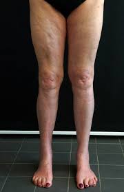 Eosinophilic fasciitis in a 65-year-old woman. Positive groove sign on... |  Download Scientific Diagram