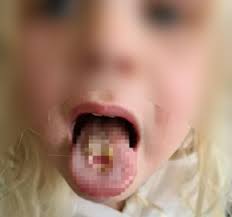 Menina descama a língua com bala ácida; dor é igual de queimadura por fogo  - 10112021 - UOL VivaBem
