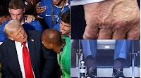 Cardiologist explains possible cause of Donald Trump’s swollen ankles, bruises: Blood clotting, liver disease, arthritis | Health