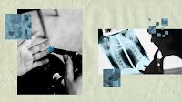 Back pain: Type 2 diabetes may affect collagen between spinal disks
