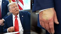 Trump covering up ‘IV wounds with makeup’? Internet hints at ‘congestive heart failure’ amid Biden deja vu