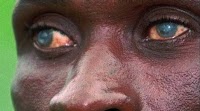 GHS to fight Onchocerciasis in Wassa East District