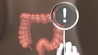 Don't skip colonoscopy for new blood-based colon cancer screening, study concludes