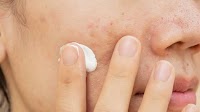 Novel Acne Scar Gel Has High Rates of Efficacy and Patient Satisfaction