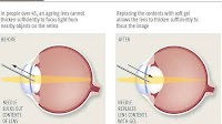 Jelly lenses could fix ageing eyes